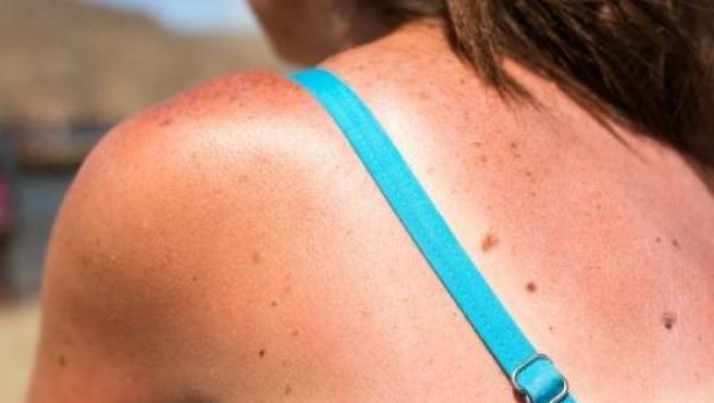 Quemaduras de sol pueden ser dañinas para la salud